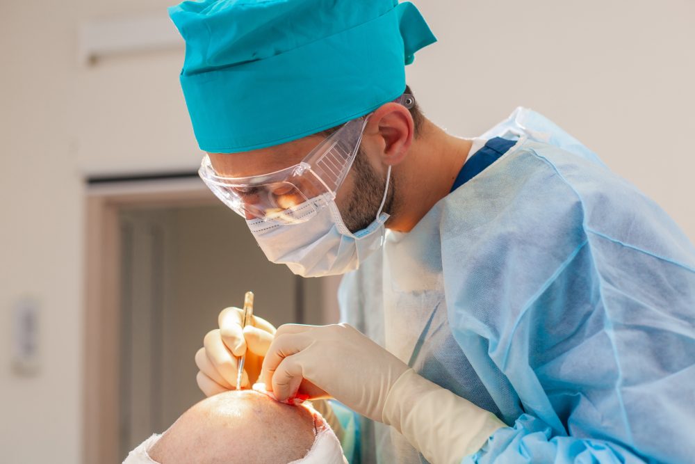 Baldness treatment. Hair transplant. Surgeons in the operating room carry out hair transplant surgery. Surgical technique that moves hair follicles from a part of the head.