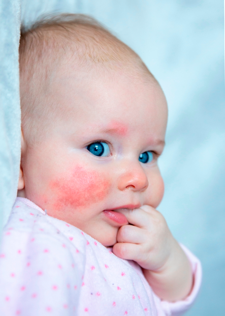 DERMATOLOGIA PEDIÁTRICA